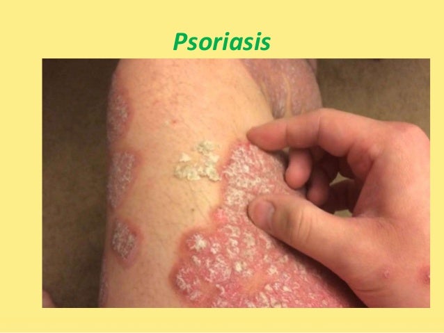 types of psoriasis psoriasis diet